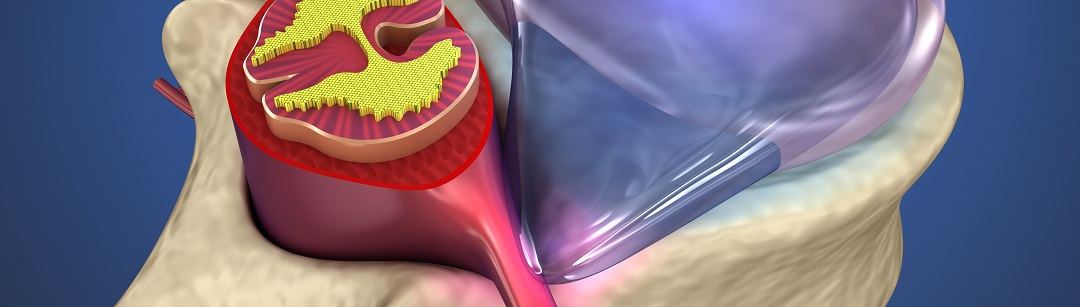 disc_hernia_SM1080